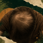 losing hair